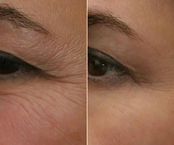 antes-x-depois-5